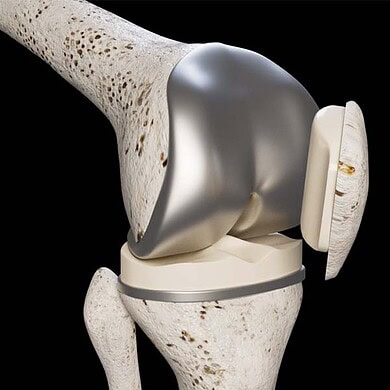 Knie-OP Totalendoprothese