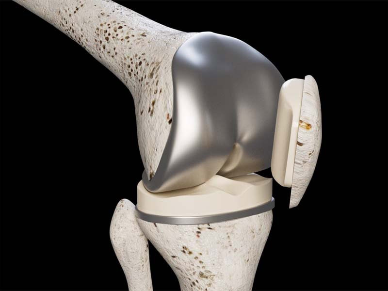 Knie-OP Totalendoprothese