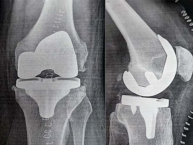 röntgenbild knie Endoprothese